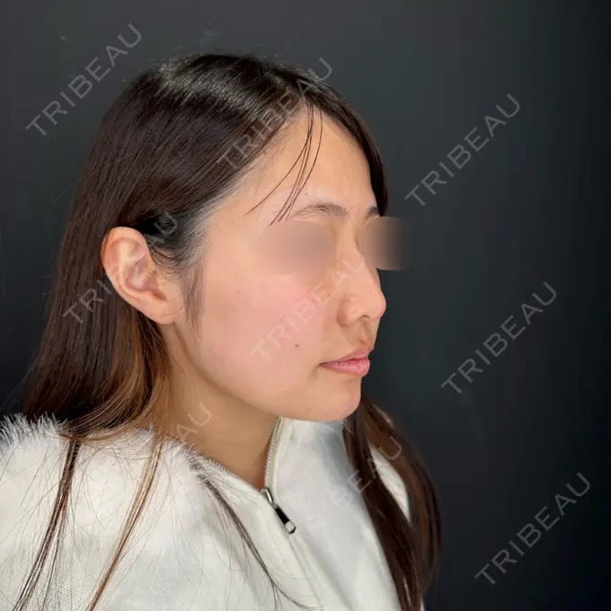 ヒアルロン酸注入（涙袋） / ヒアルロン酸注入（鼻） / ボトックス（あご） / ボトックス（エラ・小顔） HAAB×DREAM BEAUTY CLINIC 大阪梅田院 DAY 0 メイン用