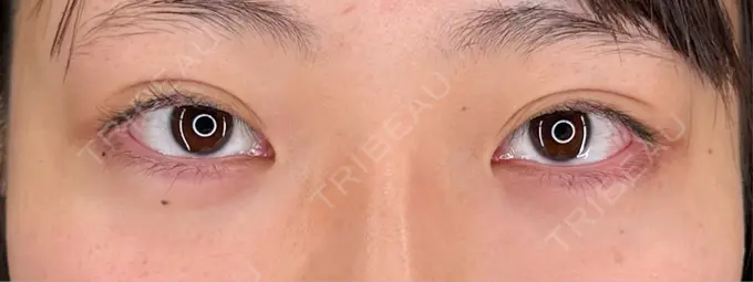 ヒアルロン酸注入（涙袋） / ヒアルロン酸注入（鼻） / ボトックス（あご） / ボトックス（エラ・小顔） HAAB×DREAM BEAUTY CLINIC 大阪梅田院 DAY 0 メイン用