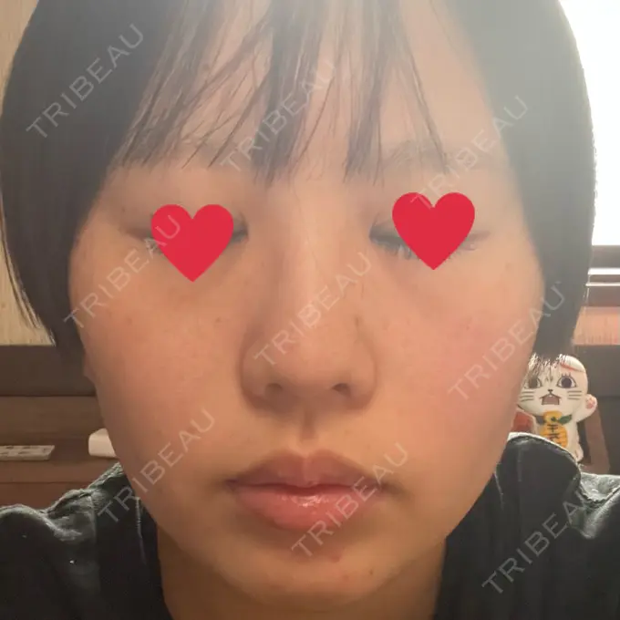 光治療（フォトフェイシャルなど） トラスト美容クリニック 銀座院 DAY 3 メイン用