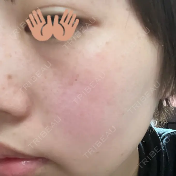 光治療（フォトフェイシャルなど） トラスト美容クリニック 銀座院 DAY 4 メイン用