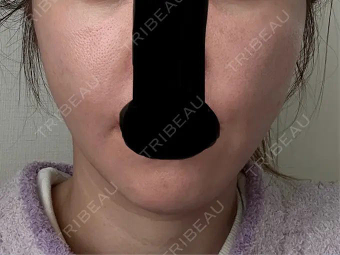 デンシティ 城本クリニック 新宿院 DAY 4 メイン用