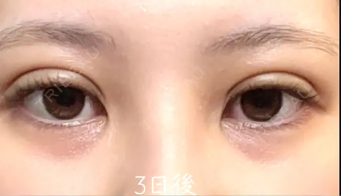 自然癒着法 eクリニック 福岡院 DAY 3 メイン用