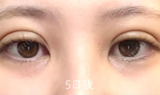 自然癒着法 eクリニック 福岡院 DAY 5 メイン用