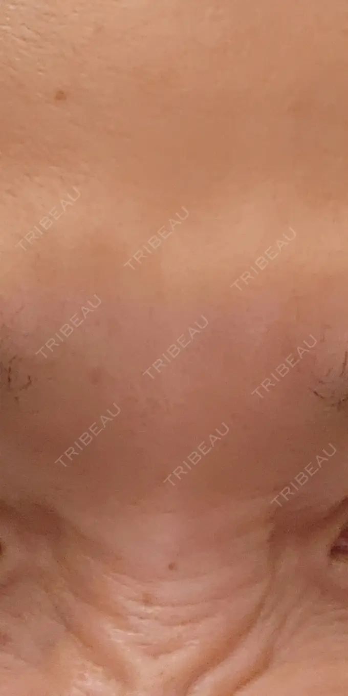 ボトックス（眉間） / ボトックス（目尻） / ボトックス（額） DMTC美容皮膚科 大宮院 DAY 9 メイン用