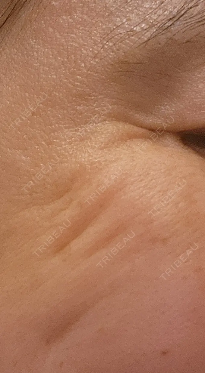 ボトックス（眉間） / ボトックス（目尻） / ボトックス（額） DMTC美容皮膚科 大宮院 DAY 9 メイン用