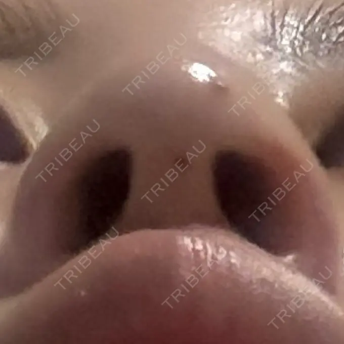 鼻孔縁挙上 シエルクリニック DAY 15 メイン用