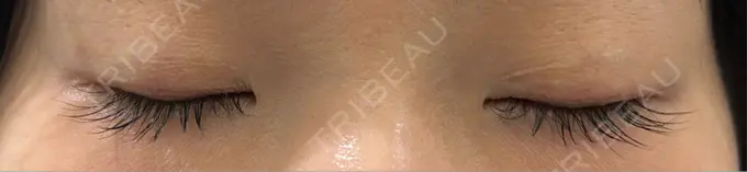 上まぶたたるみ取り / 目元修正 BIANCA銀座 AFTER メイン用