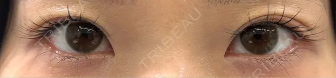 上まぶたたるみ取り / 目元修正 BIANCA銀座 DAY 45 メイン用