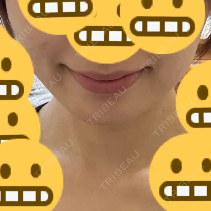 ボトックス（エラ・小顔） / ボトックス（首） DMTC CLINIC 渋谷院 DAY 10 メイン用