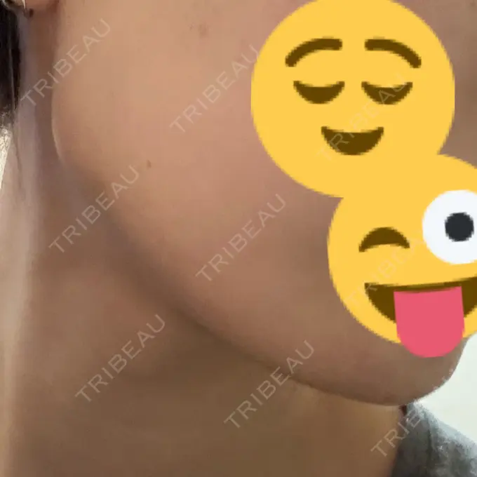 ボトックス（エラ・小顔） / ボトックス（首） DMTC CLINIC 渋谷院 DAY 10 メイン用