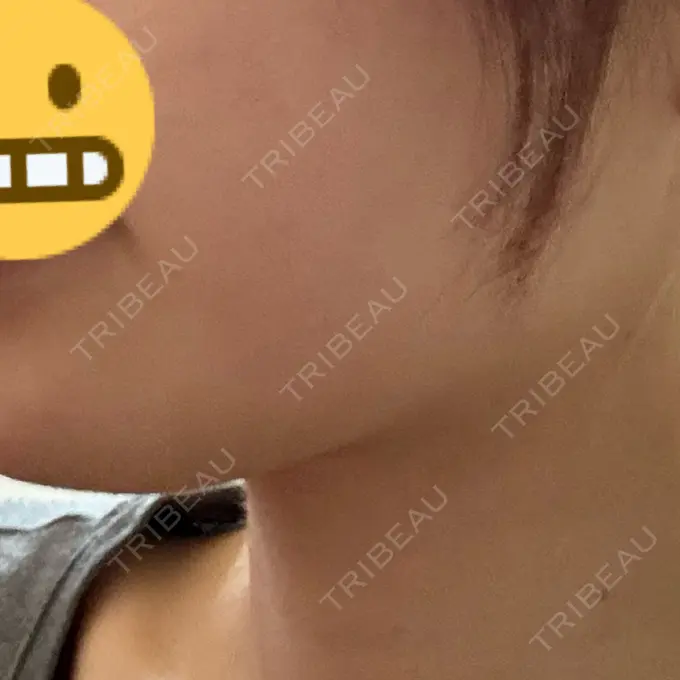 ボトックス（エラ・小顔） / ボトックス（首） DMTC CLINIC 渋谷院 DAY 10 メイン用