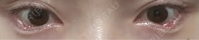 目尻切開 / タレ目形成・グラマラスライン（埋没） LOUIS CLINIC 二子玉川院【ルイクリニック】 DAY 3 メイン用