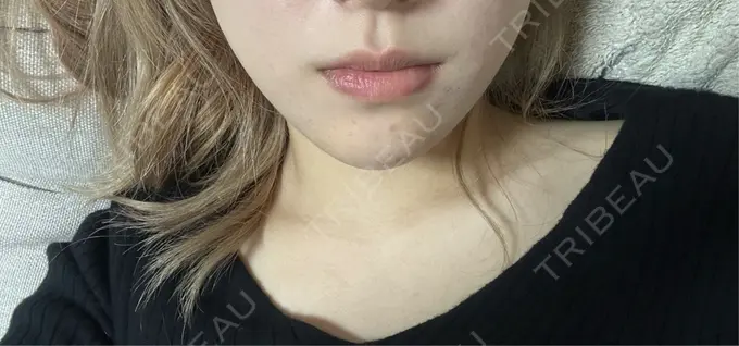 ヒアルロン酸注入（あご） 日比谷セントラルクリニック DAY 0 メイン用