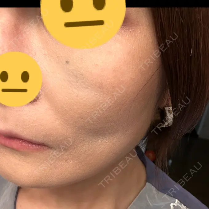 糸リフト SK新宿歌舞伎町美容外科・歯科 DAY 6 メイン用