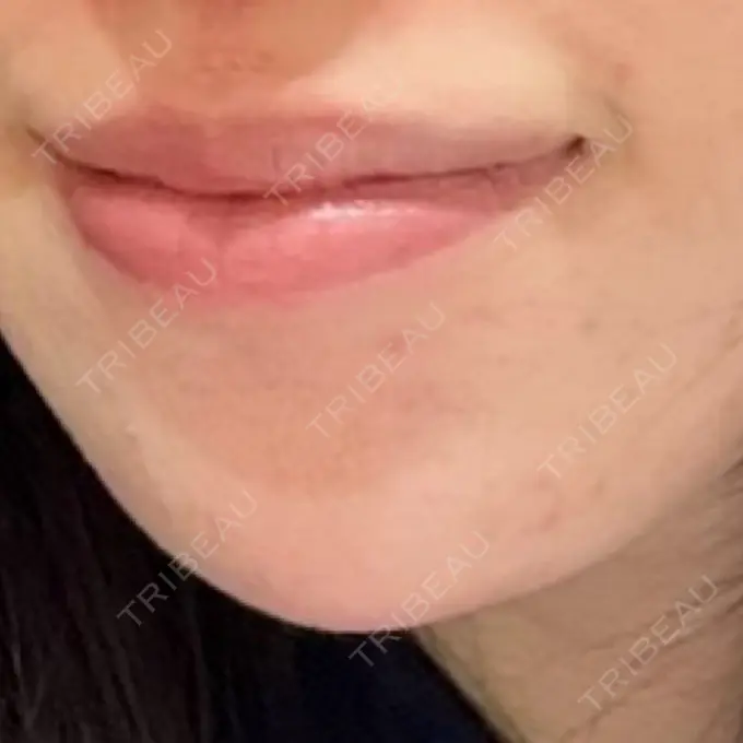 ボトックス（あご） / ヒアルロン酸注入（あご） / ヒアルロン酸注入（鼻翼基部） ジョウクリニック 大阪院 DAY 41 メイン用