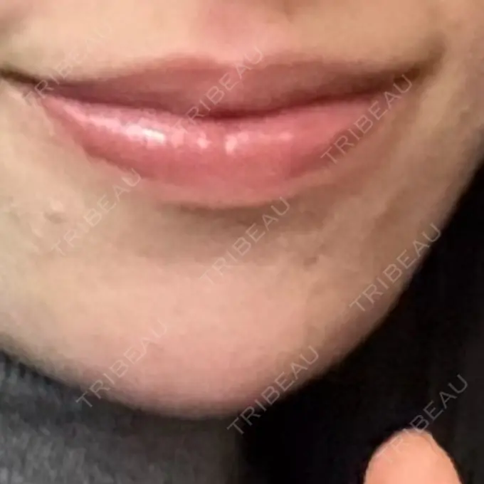 ボトックス（あご） / ヒアルロン酸注入（あご） / ヒアルロン酸注入（鼻翼基部） ジョウクリニック 大阪院 DAY 69 メイン用