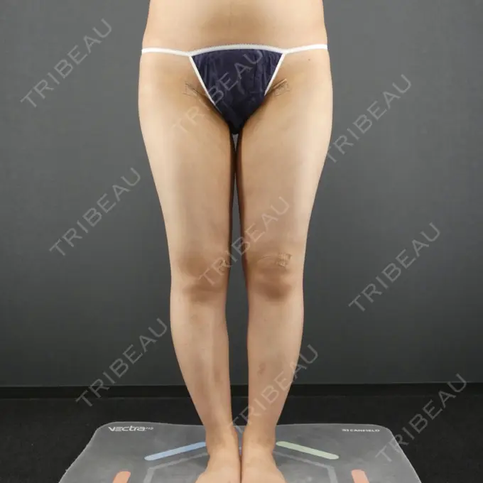 脂肪吸引（脚） GRACIA clinic 【グラシアクリニック】 AFTER メイン用