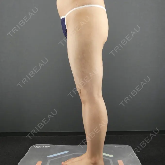 脂肪吸引（脚） GRACIA clinic 【グラシアクリニック】 DAY 35 メイン用