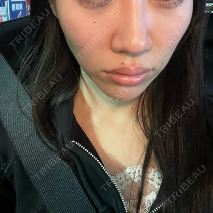 ヒアルロン酸注入（涙袋） / 肌ヒアルロン酸注入（たるみ・シワ改善） / ヒアルロン酸注入（唇） / ヒアルロン酸注入（目の下） 共立美容外科 神戸三宮院 DAY 2 メイン用