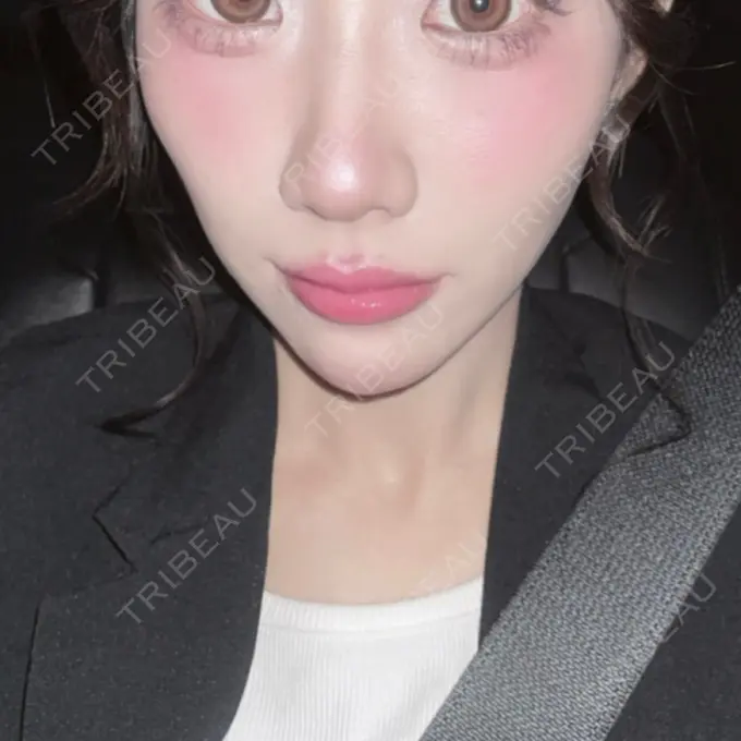 ヒアルロン酸注入（涙袋） / 肌ヒアルロン酸注入（たるみ・シワ改善） / ヒアルロン酸注入（唇） / ヒアルロン酸注入（目の下） 共立美容外科 神戸三宮院 DAY 2 メイン用