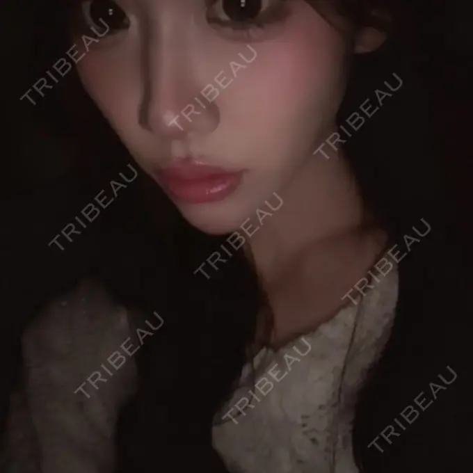 ヒアルロン酸注入（涙袋） / 肌ヒアルロン酸注入（たるみ・シワ改善） / ヒアルロン酸注入（唇） / ヒアルロン酸注入（目の下） 共立美容外科 神戸三宮院 AFTER メイン用