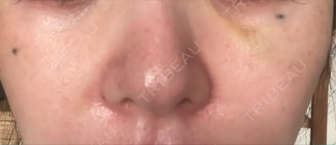 ヒアルロン酸注入（目の下） / ヒアルロン酸注入（鼻翼基部） 湘南美容クリニック 博多院 DAY 7 メイン用