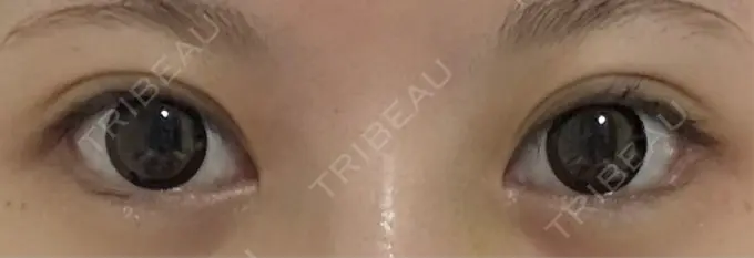 目尻切開 / タレ目形成・グラマラスライン（埋没） LOUIS CLINIC 二子玉川院【ルイクリニック】 DAY 11 メイン用