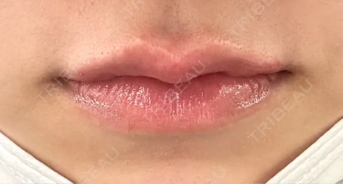 ヒアルロン酸注入（唇） 目白ホワイトクリニック DAY 0 メイン用