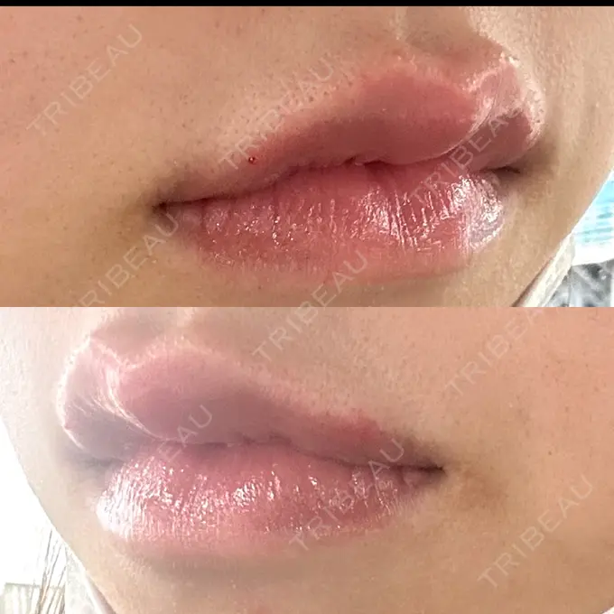 ヒアルロン酸注入（唇） 目白ホワイトクリニック DAY 0 メイン用