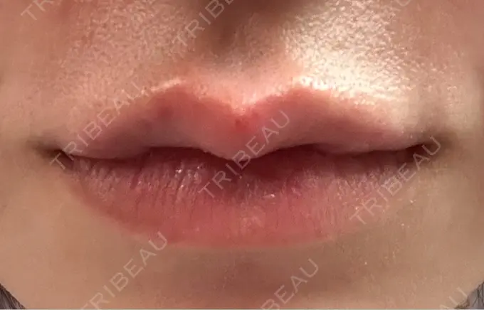 ヒアルロン酸注入（唇） 目白ホワイトクリニック DAY 1 メイン用