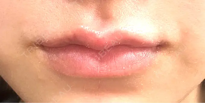 ヒアルロン酸注入（唇） 目白ホワイトクリニック DAY 2 メイン用