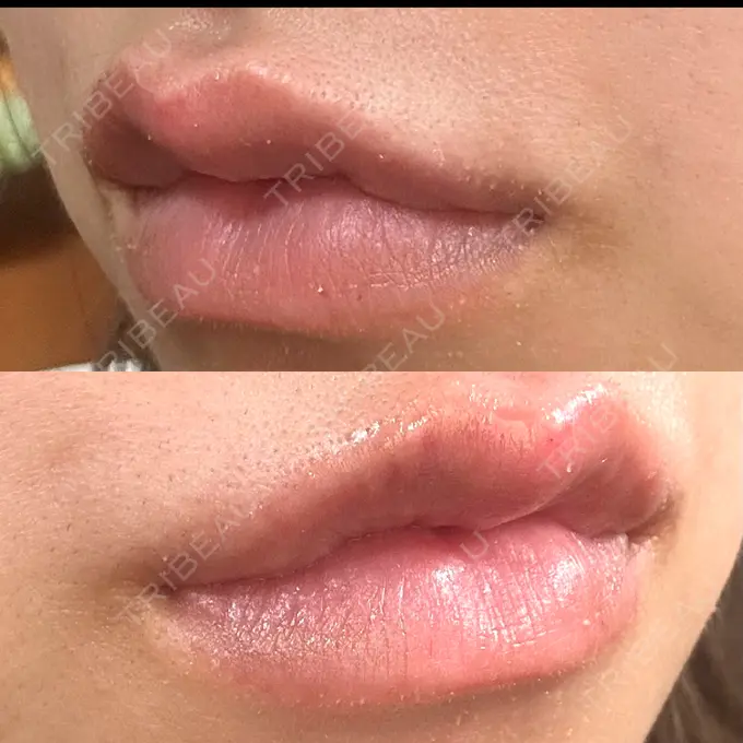 ヒアルロン酸注入（唇） 目白ホワイトクリニック DAY 2 メイン用