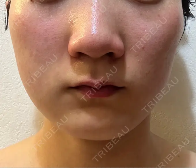 その他（輪郭） 横浜TAクリニック AFTER メイン用