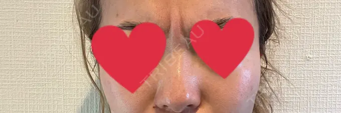 ボトックス（あご） / ボトックス（口角） / ボトックス（眉間） / ボトックス（目尻） / ボトックス（額） / ボトックス（人中） / ボトックス（ガミースマイル） DMTC CLINIC 渋谷院 DAY 1 メイン用