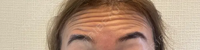 ボトックス（あご） / ボトックス（口角） / ボトックス（眉間） / ボトックス（目尻） / ボトックス（額） / ボトックス（人中） / ボトックス（ガミースマイル） DMTC CLINIC 渋谷院 DAY 1 メイン用