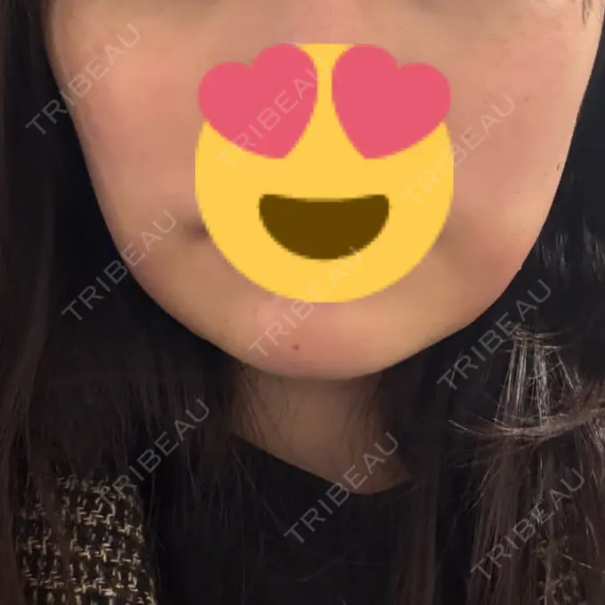 脂肪吸引（顔） / 脂肪吸引注射（顔） ziz CLINIC DAY 1 メイン用