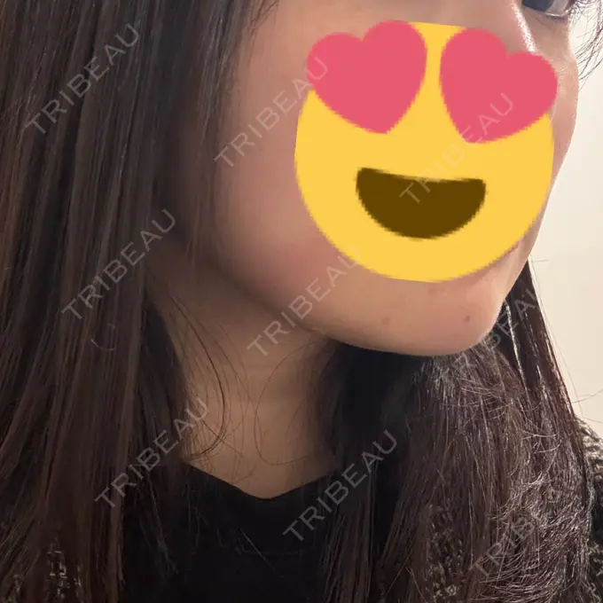 脂肪吸引（顔） / 脂肪吸引注射（顔） ziz CLINIC DAY 1 メイン用