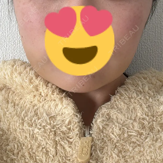 脂肪吸引（顔） / 脂肪吸引注射（顔） ziz CLINIC AFTER メイン用