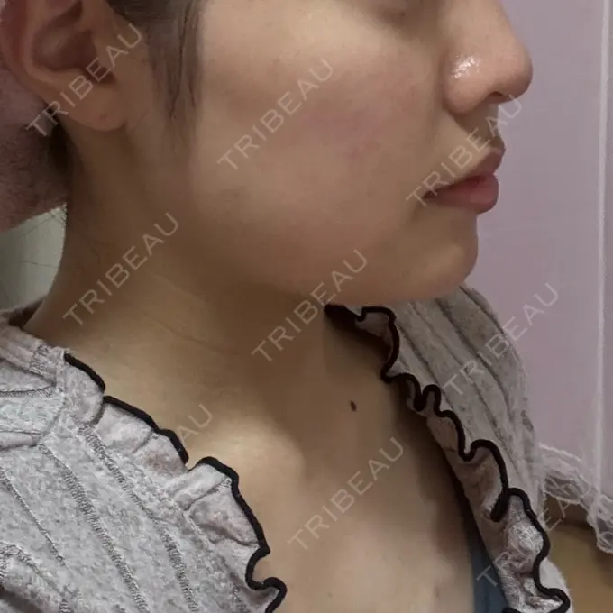 ヒアルロン酸注入（涙袋） / ヒアルロン酸注入（鼻） / ボトックス（あご） / ボトックス（エラ・小顔） HAAB×DREAM BEAUTY CLINIC 大阪梅田院 DAY 1 メイン用