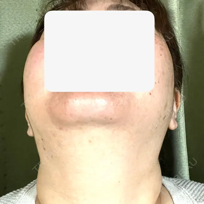 ボトックス（エラ・小顔） / 脂肪溶解注射（顔） / 脂肪溶解注射（お腹） Jfeel（ジェイフィール）クリニック-ホンデ院 DAY 5 メイン用