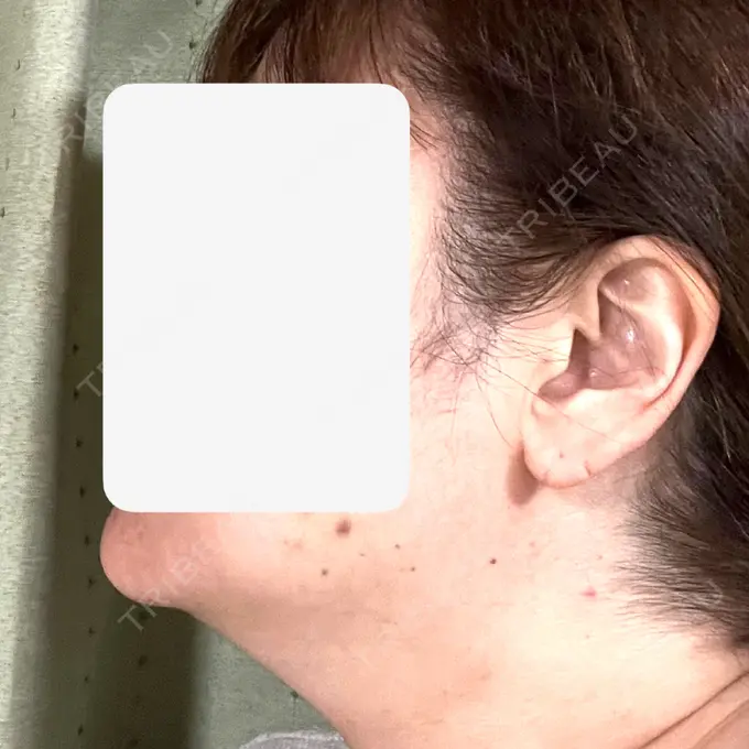 ボトックス（エラ・小顔） / 脂肪溶解注射（顔） / 脂肪溶解注射（お腹） Jfeel（ジェイフィール）クリニック-ホンデ院 DAY 5 メイン用