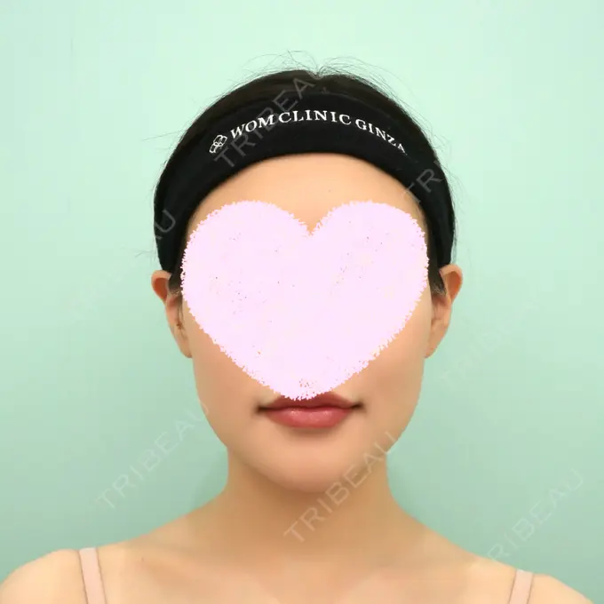 骨切り（あご） / 脂肪吸引（顔） WOM CLINIC GINZA （ワム クリニック ギンザ） AFTER メイン用