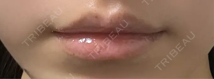 ヒアルロン酸注入（涙袋） / ヒアルロン酸注入（唇） アリエル美容クリニック 横浜院 DAY 5 メイン用