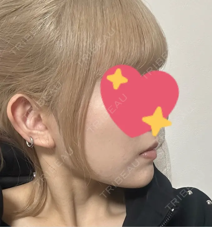 ヒアルロン酸注入（あご） 日比谷セントラルクリニック DAY 1 メイン用