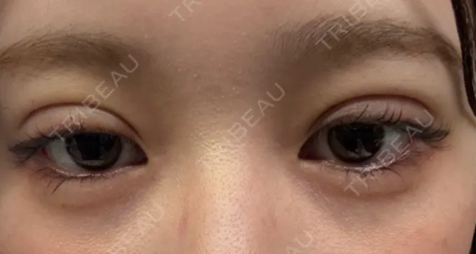 二重埋没 恵聖会クリニック 京橋院 DAY 2 メイン用