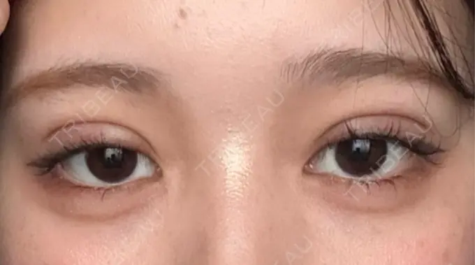 二重埋没 恵聖会クリニック 京橋院 DAY 1 メイン用