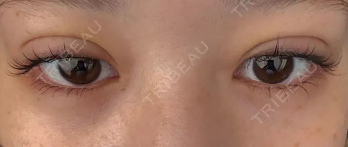 二重埋没 恵聖会クリニック 京橋院 DAY 3 メイン用