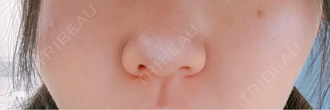 肌育注射（ジュベルックなど） 東京シルククリニック 新宿院 DAY 4 メイン用