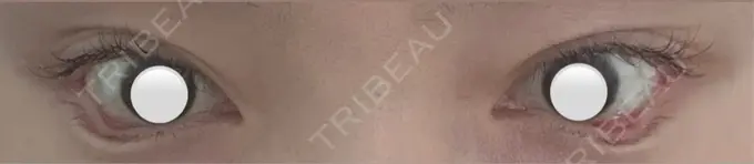 目尻切開 / タレ目形成・グラマラスライン（埋没） LOUIS CLINIC 二子玉川院【ルイクリニック】 DAY 5 メイン用