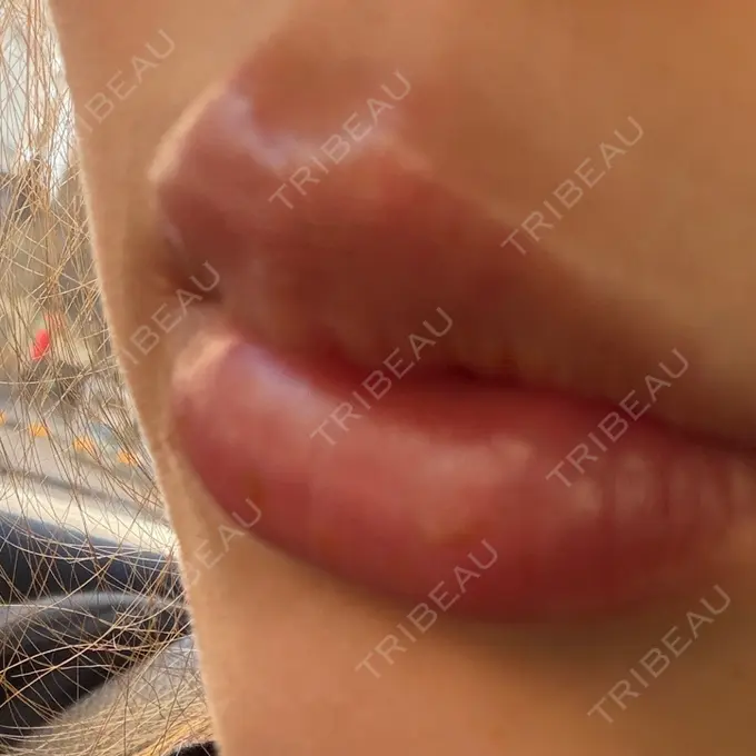 ヒアルロン酸注入（唇） 小倉美容外科/美容皮膚科 ビラビューティークリニック AFTER メイン用